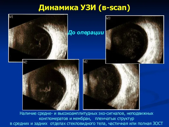 Динамика УЗИ (в-scan) До операции Наличие средне- и высокоамплитудных эхо-сигналов, неподвижных