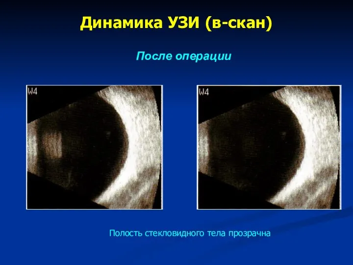 Динамика УЗИ (в-скан) После операции Полость стекловидного тела прозрачна