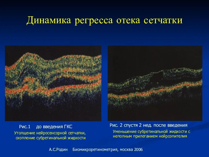 Динамика регресса отека сетчатки Утолщение нейросенсорной сетчатки, скопление субретинальной жидкости Рис.1