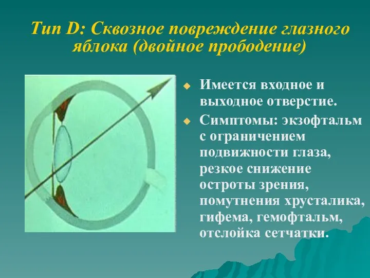 Тип D: Сквозное повреждение глазного яблока (двойное прободение) Имеется входное и