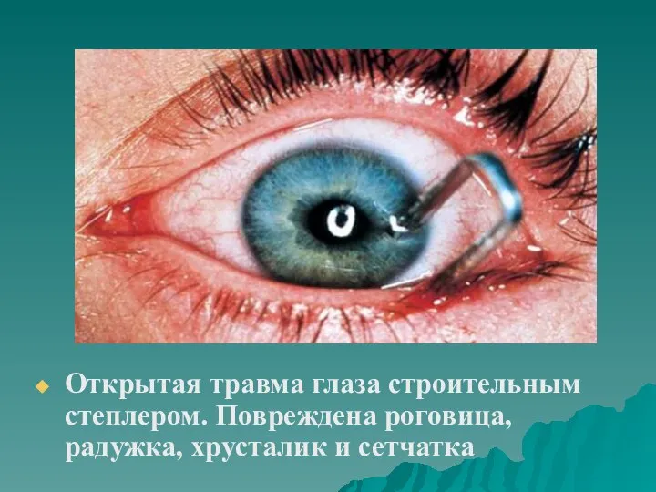 Открытая травма глаза строительным степлером. Повреждена роговица, радужка, хрусталик и сетчатка