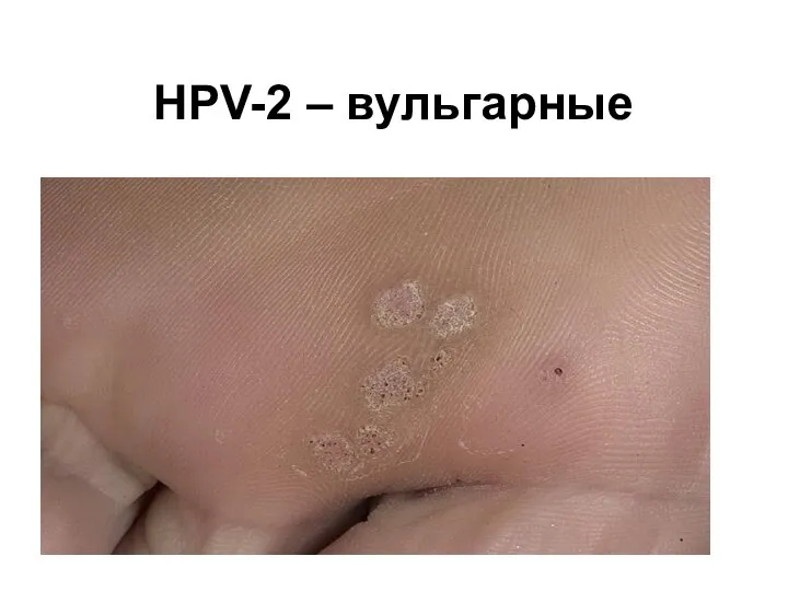 HPV-2 – вульгарные