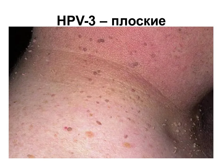 HPV-3 – плоские