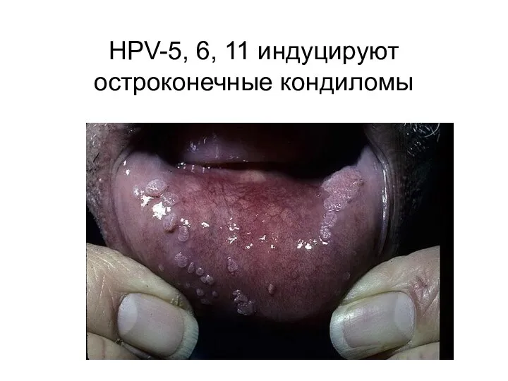 HPV-5, 6, 11 индуцируют остроконечные кондиломы