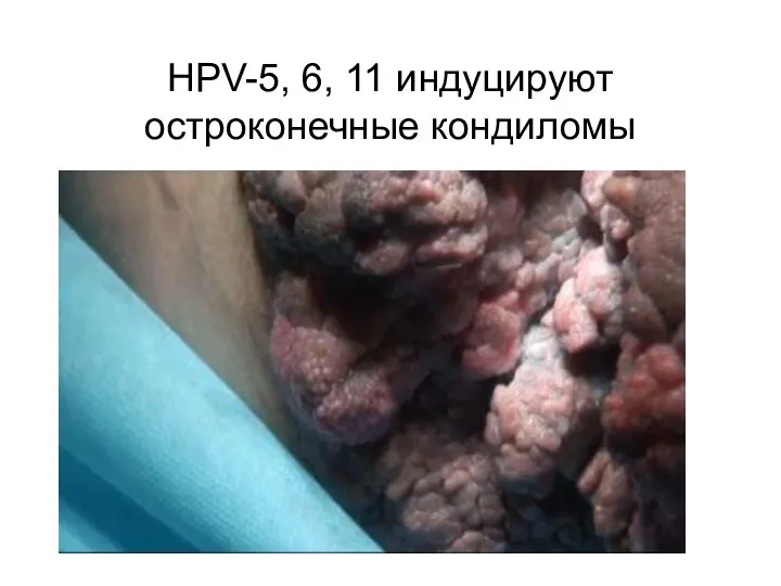 HPV-5, 6, 11 индуцируют остроконечные кондиломы