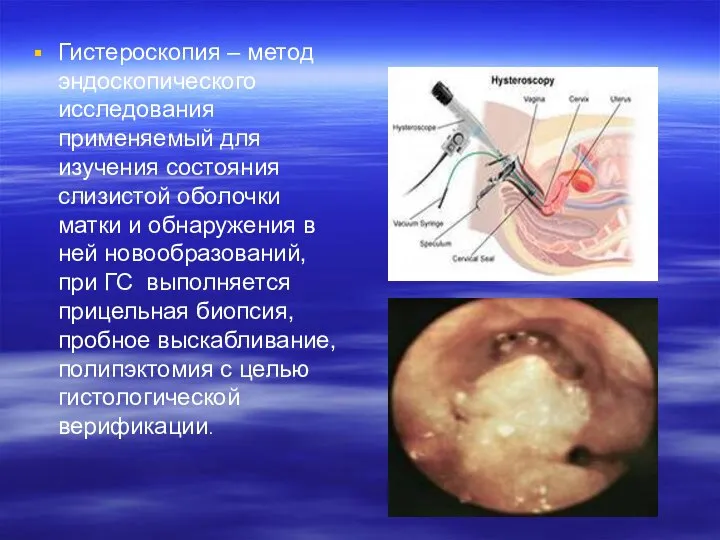Гистероскопия – метод эндоскопического исследования применяемый для изучения состояния слизистой оболочки
