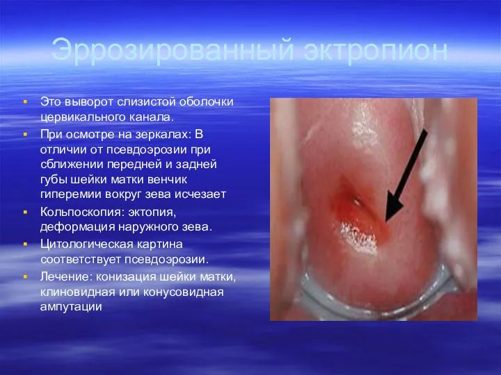 Эррозированный эктропион Это выворот слизистой оболочки цервикального канала. При осмотре на