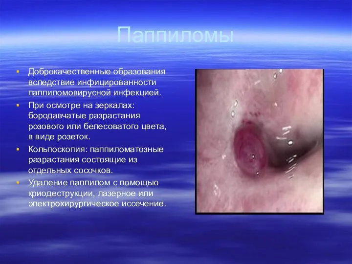 Паппиломы Доброкачественные образования вследствие инфицированности паппиломовирусной инфекцией. При осмотре на зеркалах:
