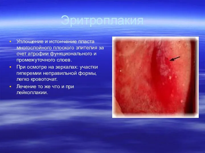 Эритроплакия Уплощение и истончение пласта многослойного плоского эпителия за счет атрофии