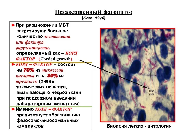 Незавершенный фагоцитоз (Kato, 1970) ►При размножении МБТ секретируют большое количество экзотоксина