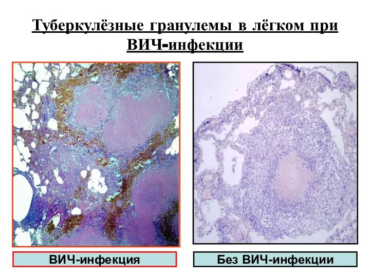 Туберкулёзные гранулемы в лёгком при ВИЧ-инфекции Без ВИЧ-инфекции ВИЧ-инфекция