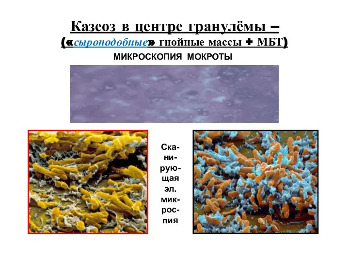 Казеоз в центре гранулёмы – («сыроподобные» гнойные массы + МБТ) МИКРОСКОПИЯ