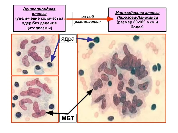 Многоядерная клетка Пирогова-Лангханса (размер 80-100 мкм и более) Эпителиоидная клетка (увеличение
