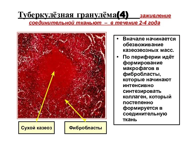 Туберкулёзная гранулёма(4) заживление соединительной тканьют – в течение 2-4 года Вначале