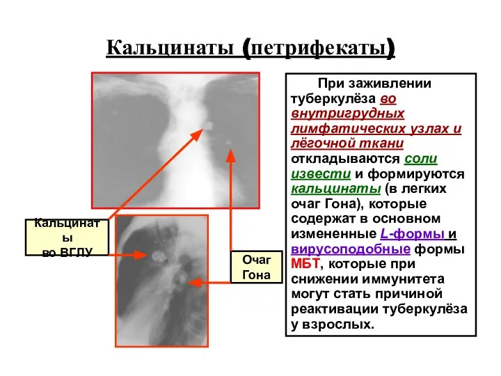 Кальцинаты (петрифекаты) При заживлении туберкулёза во внутригрудных лимфатических узлах и лёгочной