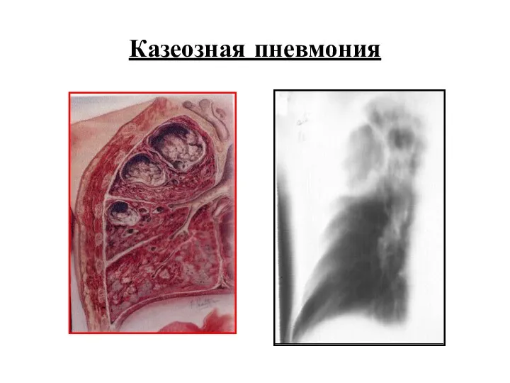 Казеозная пневмония