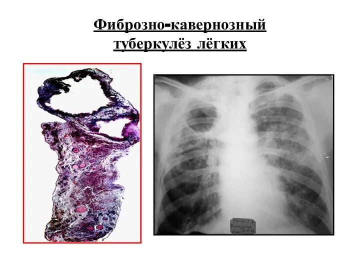 Фиброзно-кавернозный туберкулёз лёгких