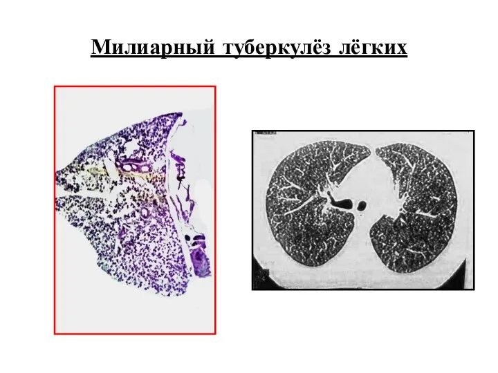 Милиарный туберкулёз лёгких