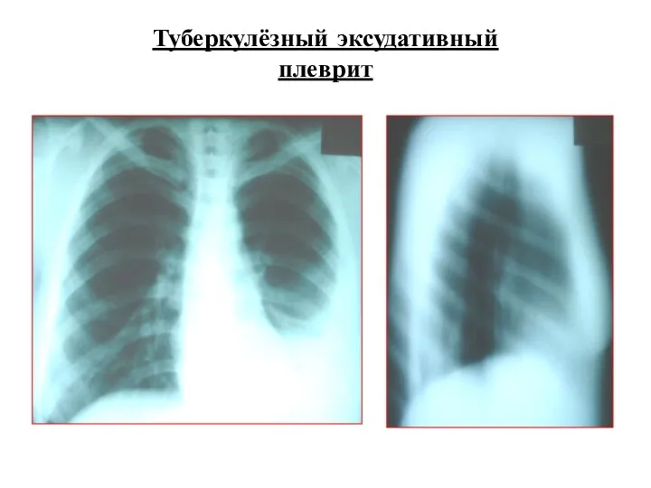 Туберкулёзный эксудативный плеврит