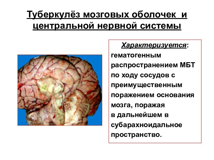 Туберкулёз мозговых оболочек и центральной нервной системы Характеризуется: гематогенным распространением МБТ