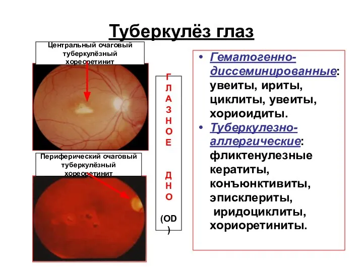 Туберкулёз глаз Гематогенно- диссеминированные: увеиты, ириты, циклиты, увеиты, хориоидиты. Туберкулезно- аллергические: