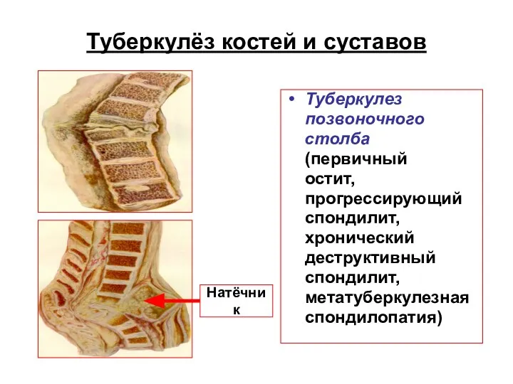 Туберкулёз костей и суставов Туберкулез позвоночного столба (первичный остит, прогрессирующий спондилит,