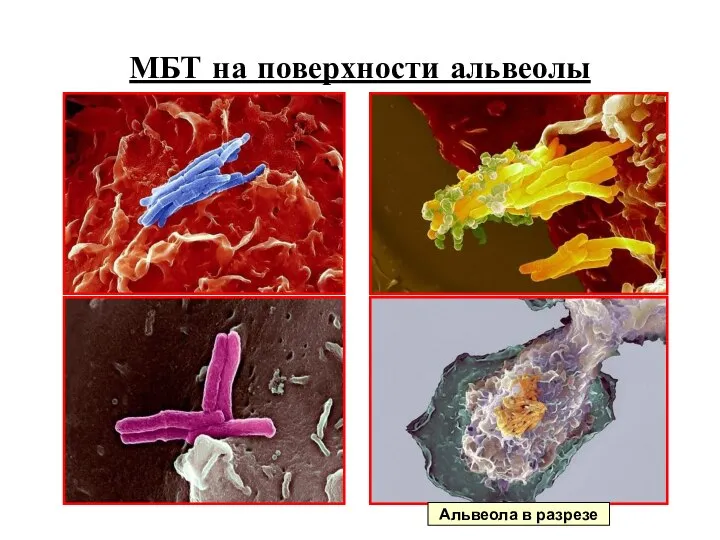 МБТ на поверхности альвеолы Альвеола в разрезе