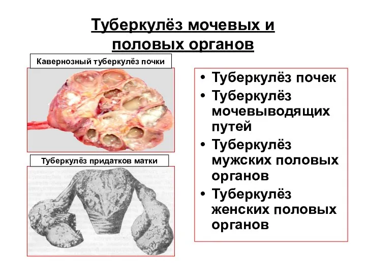 Туберкулёз мочевых и половых органов Туберкулёз почек Туберкулёз мочевыводящих путей Туберкулёз