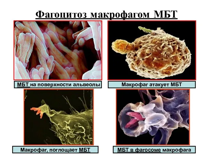Фагоцитоз макрофагом МБТ МБТ на поверхности альвеолы Макрофаг, поглощает МБТ МБТ