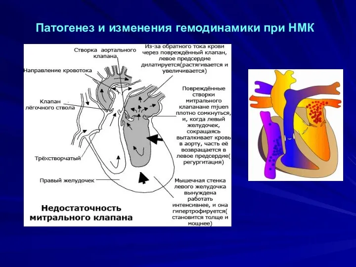 Патогенез и изменения гемодинамики при НМК