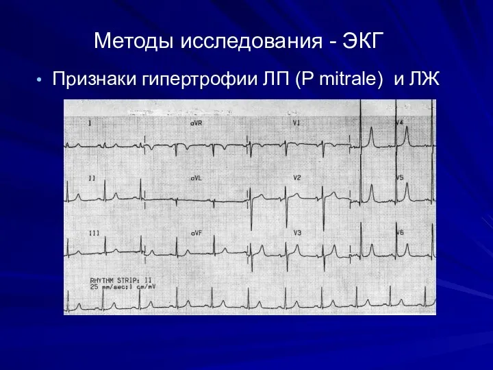 Методы исследования - ЭКГ Признаки гипертрофии ЛП (P mitrale) и ЛЖ