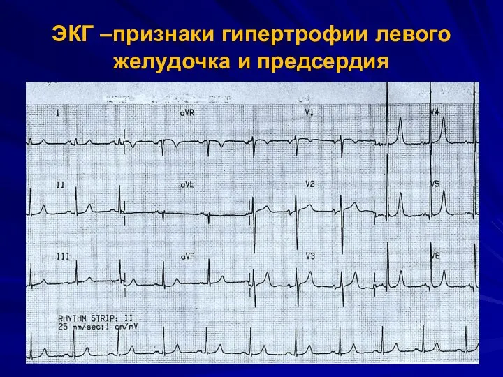ЭКГ –признаки гипертрофии левого желудочка и предсердия