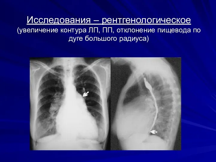 Исследования – рентгенологическое (увеличение контура ЛП, ПП, отклонение пищевода по дуге большого радиуса)