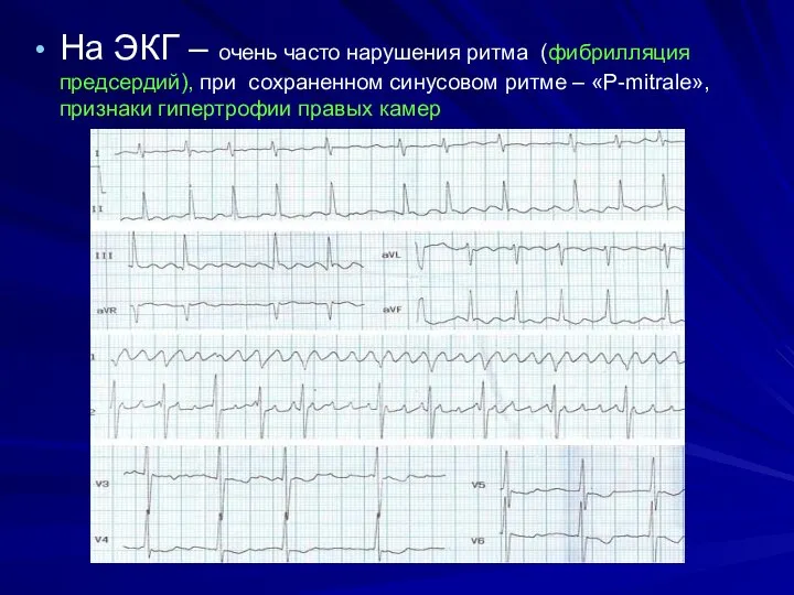 На ЭКГ – очень часто нарушения ритма (фибрилляция предсердий), при сохраненном