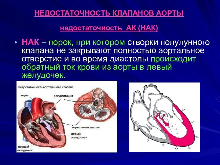 НЕДОСТАТОЧНОСТЬ КЛАПАНОВ АОРТЫ недостаточность АК (НАК) НАК – порок, при котором