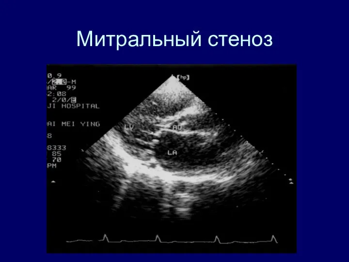 Митральный стеноз