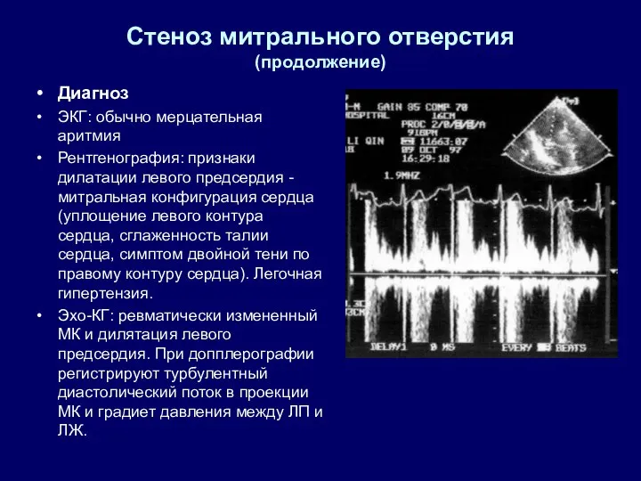 Стеноз митрального отверстия (продолжение) Диагноз ЭКГ: обычно мерцательная аритмия Рентгенография: признаки