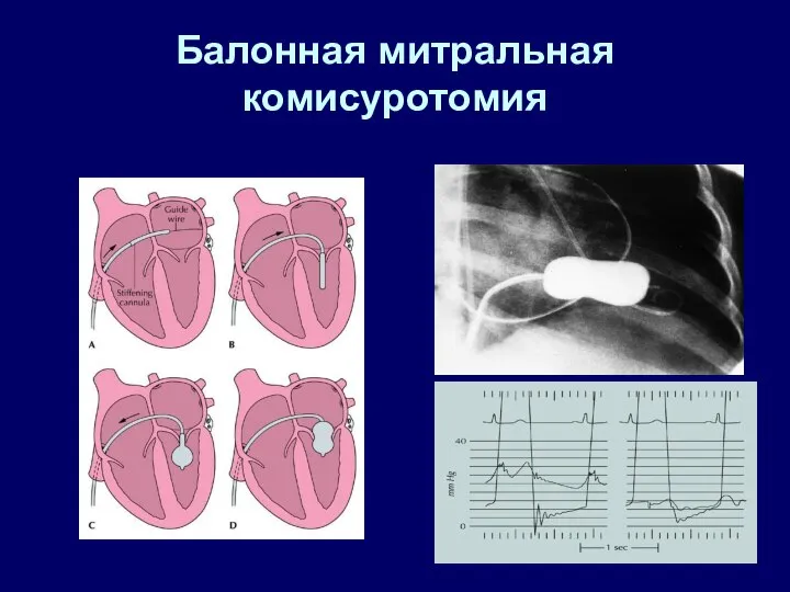 Балонная митральная комисуротомия