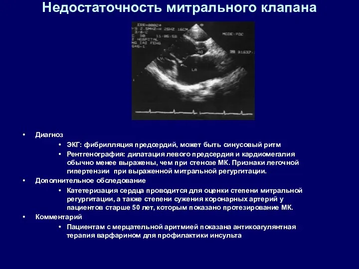 Недостаточность митрального клапана Диагноз ЭКГ: фибрилляция предсердий, может быть синусовый ритм