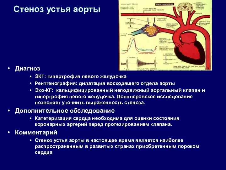 Стеноз устья аорты Диагноз ЭКГ: гипертрофия левого желудочка Рентгенография: дилатация восходящего