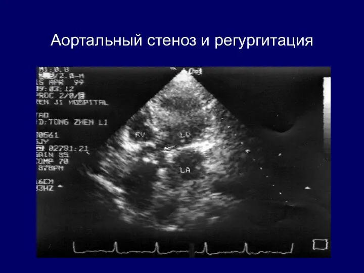 Аортальный стеноз и регургитация