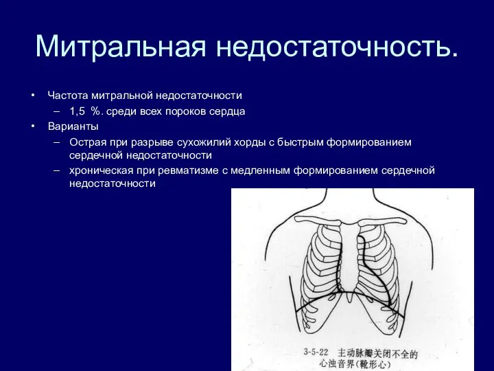 Митральная недостаточность. Частота митральной недостаточности 1,5 %. среди всех пороков сердца