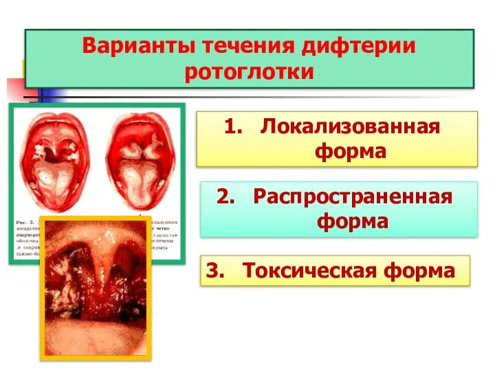 Варианты течения дифтерии ротоглотки Локализованная форма Распространенная форма Токсическая форма