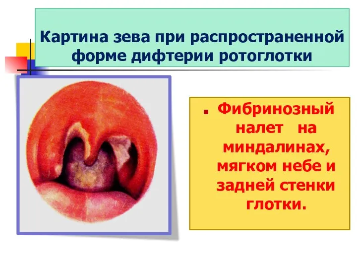 Картина зева при распространенной форме дифтерии ротоглотки Фибринозный налет на миндалинах,