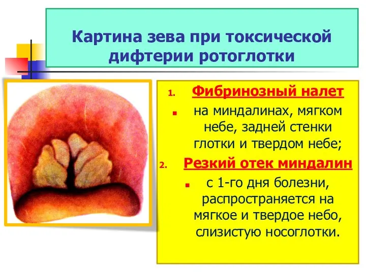 Картина зева при токсической дифтерии ротоглотки Фибринозный налет на миндалинах, мягком