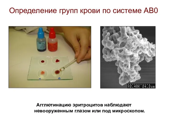 Определение групп крови по системе АВ0 Агглютинацию эритроцитов наблюдают невооруженным глазом или под микроскопом.