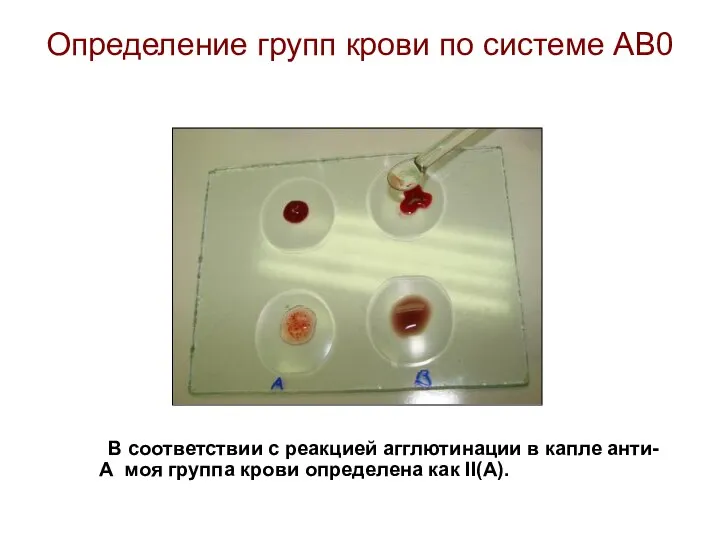 Определение групп крови по системе АВ0 В соответствии с реакцией агглютинации