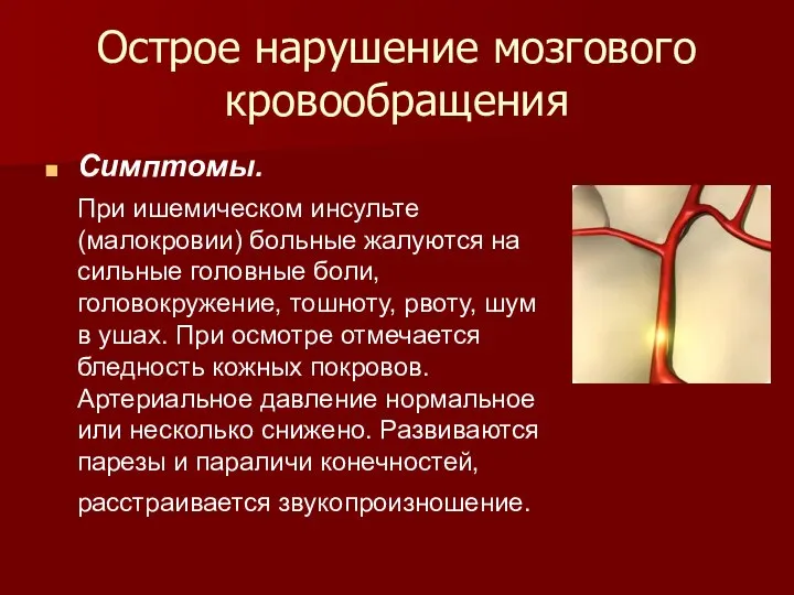 Острое нарушение мозгового кровообращения Симптомы. При ишемическом инсульте (малокровии) больные жалуются