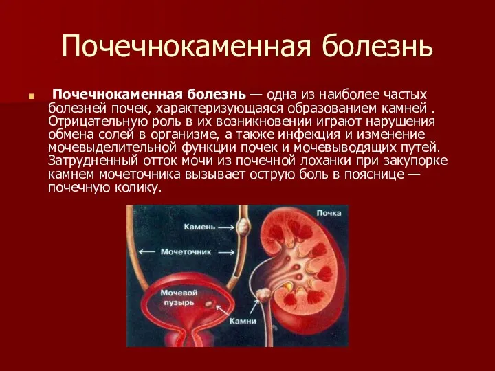 Почечнокаменная болезнь Почечнокаменная болезнь — одна из наиболее частых болезней почек,