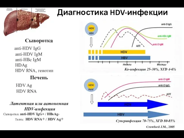 Диагностика HDV-инфекции Сыворотка anti-HDV IgG anti-HDV IgM anti-HBc IgM HDAg HDV